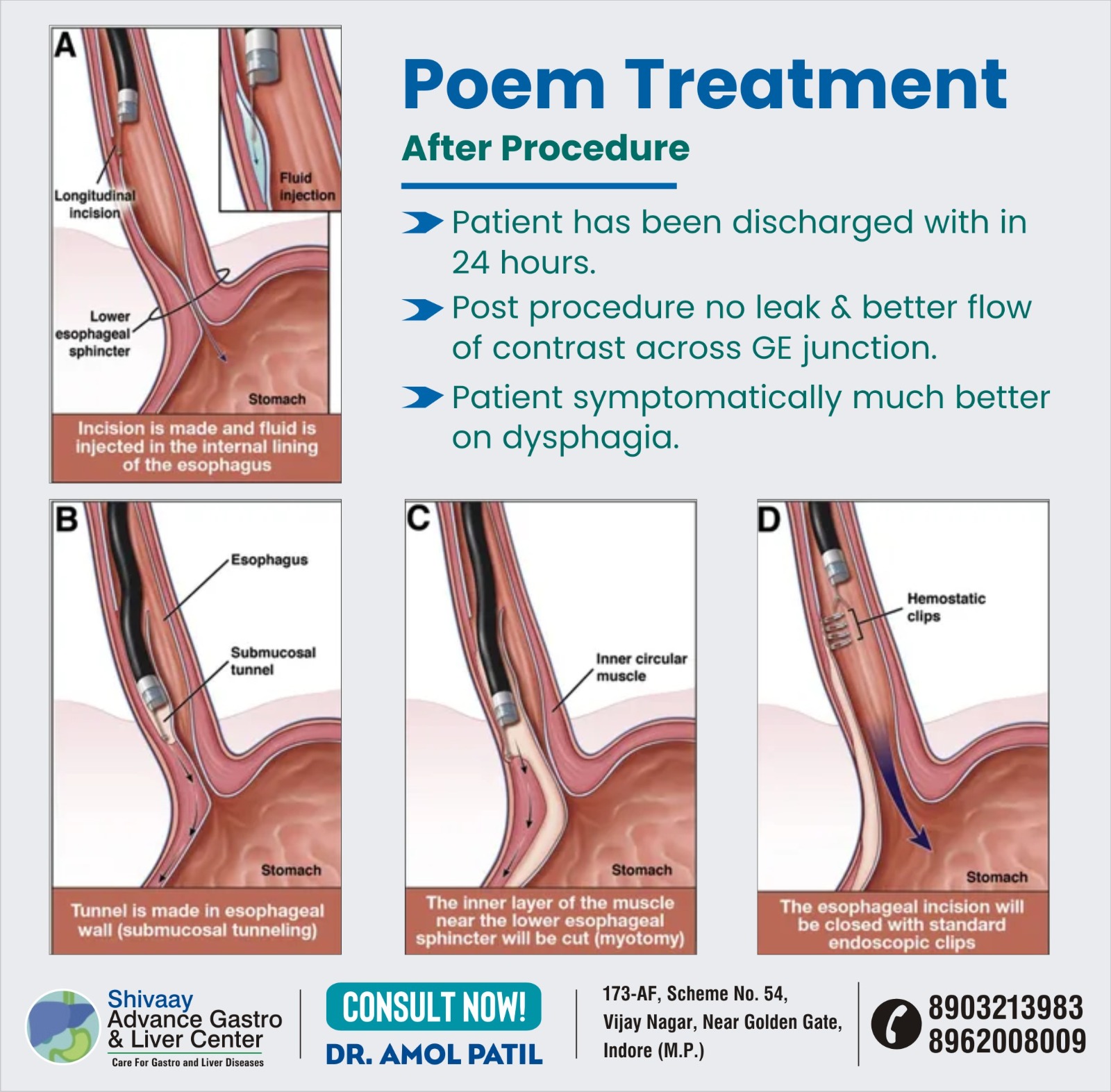 Best Doctor for POEM Treatment in Indore