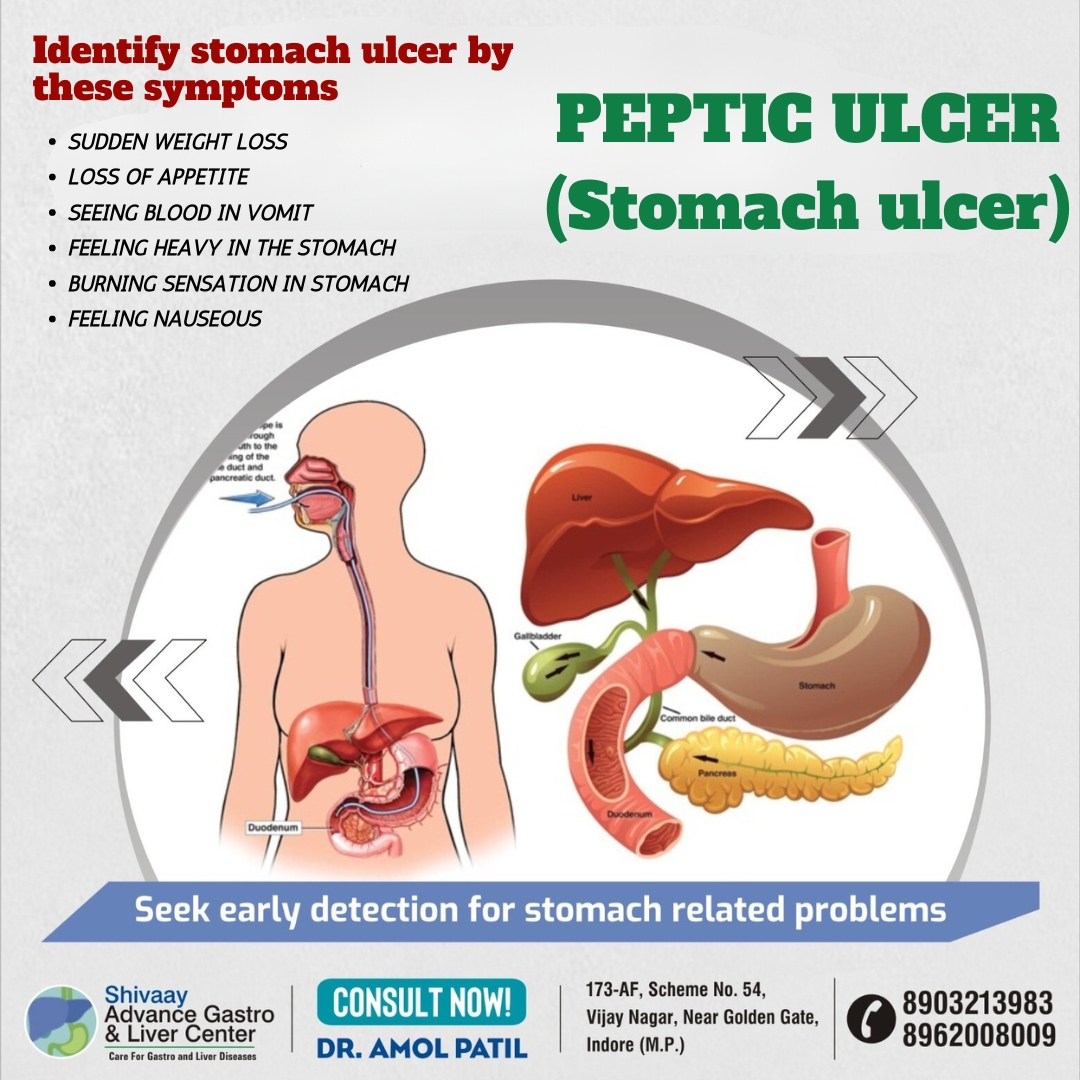 Best Doctor for Stomach Ulcer Treatment in Indore